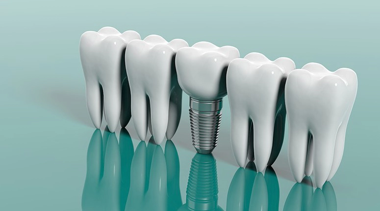 임플란트 종류 시술과정 및 임플란트 후 교정 김태희 수지 효과