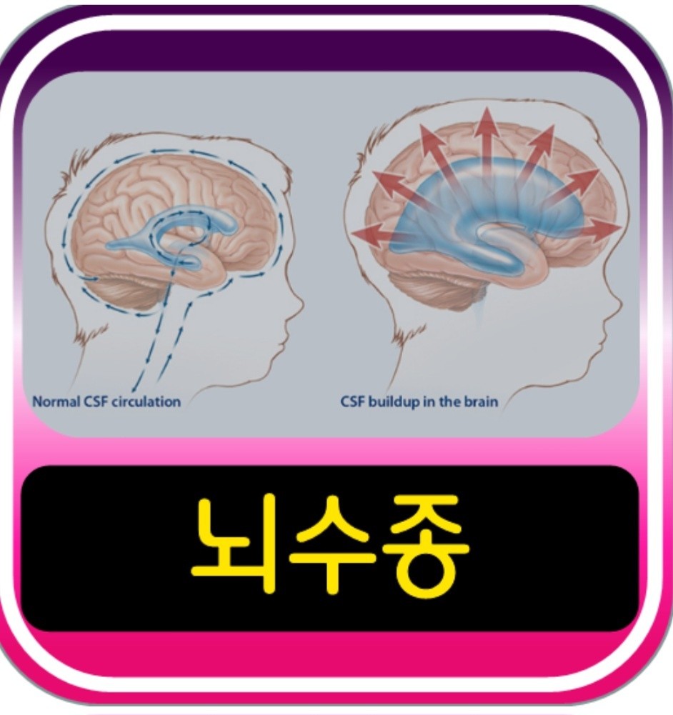 뇌수종 사진