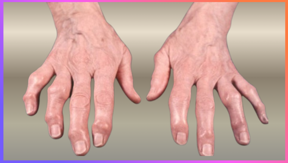 류마티스 관절염 치료 지연으로 발생한 손가락 관절 변형 모습