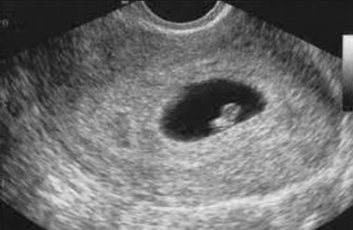 임신 6주차 태아크기 아기집 초음파 정보