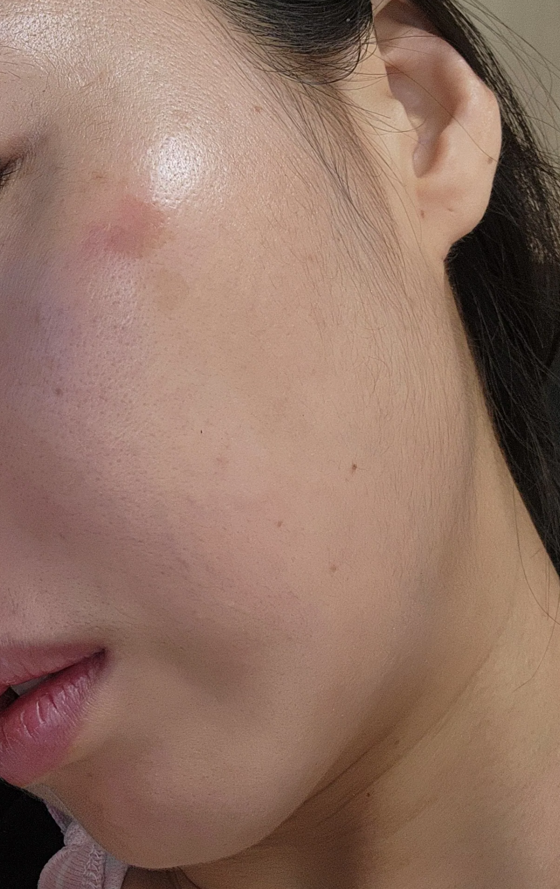 흑자치료 루비레이저 하기전 사진 우