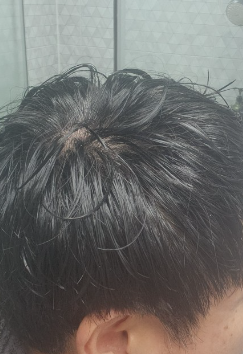 탈모약_1위_닥터메리디안