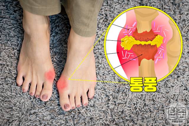 통풍에 좋은 음식 통풍에 좋은 고기