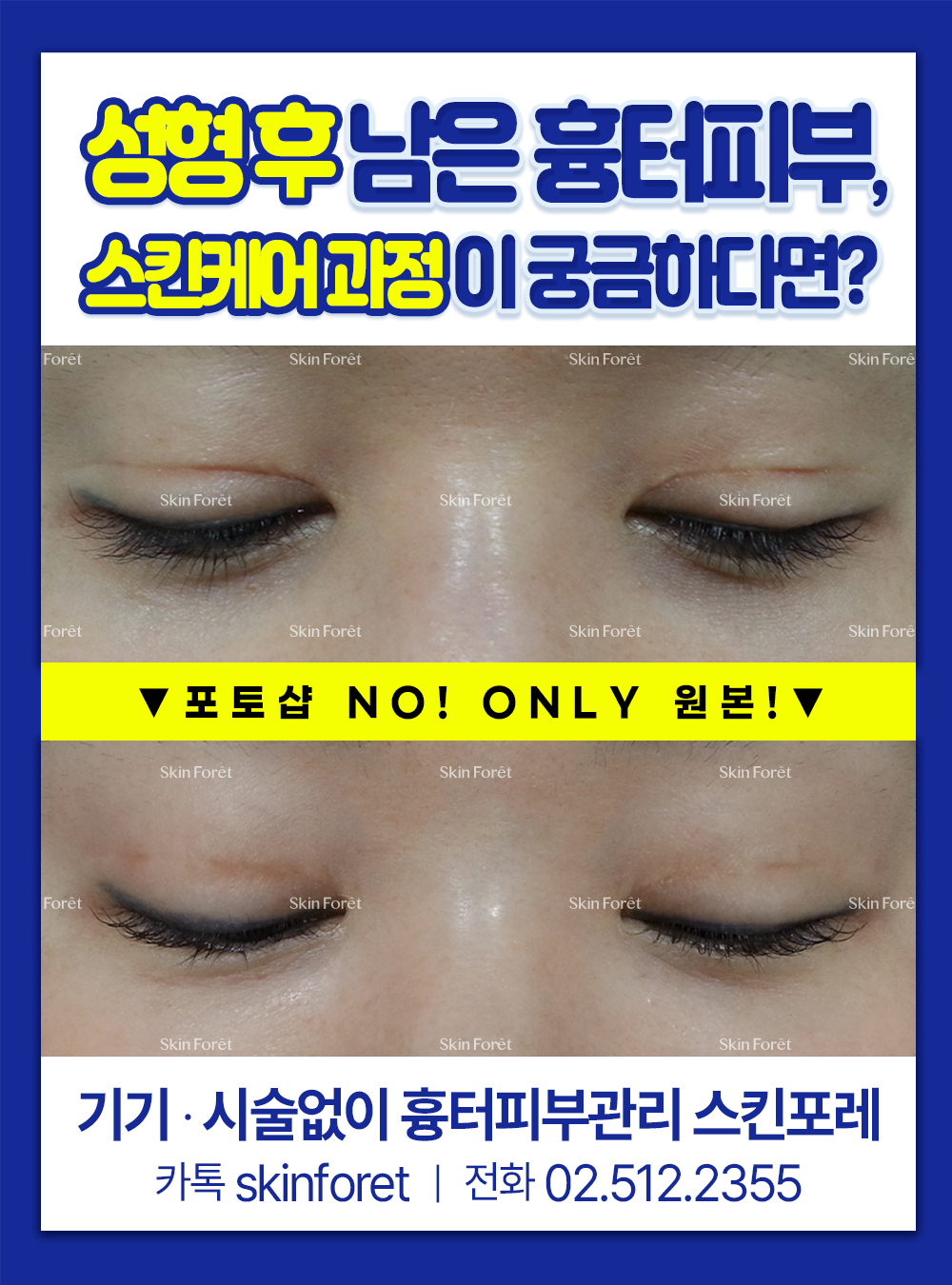 눈매교정과 쌍꺼풀 흉터 개선 전후 리얼 후기 이미지