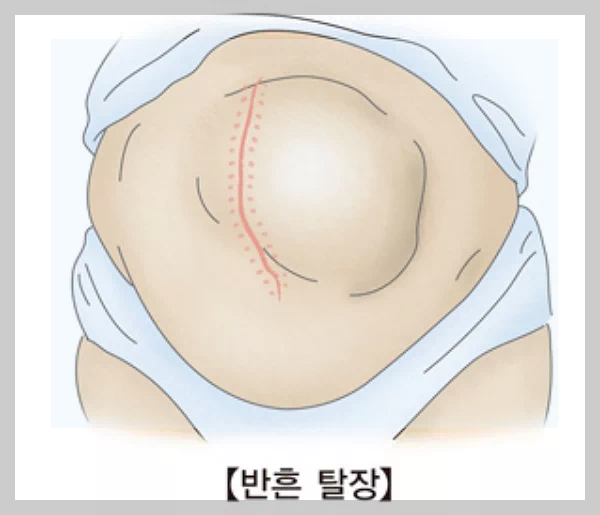 수술 부위 반흔 탈장