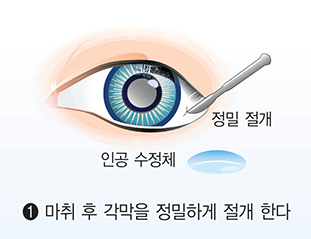백내장 수술비용 총정리!👁️