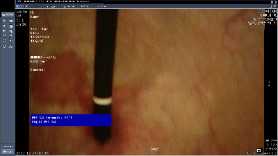 방광암 내시경 사진