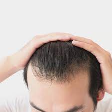 바이오틴 탈모샴푸 추천 효과 (내돈내산 솔직후기)