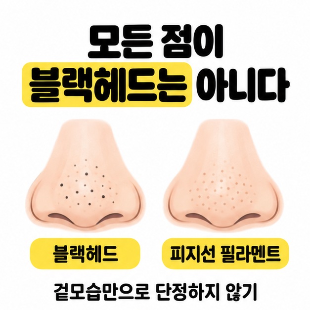 검은 점이 뚜렷한 코와 옅은 점이 고르게 있는 코를 블랙헤드와 피지선 필라멘트로 비교하며 겉모습만으로 단정하지 않도록 안내한 그림
