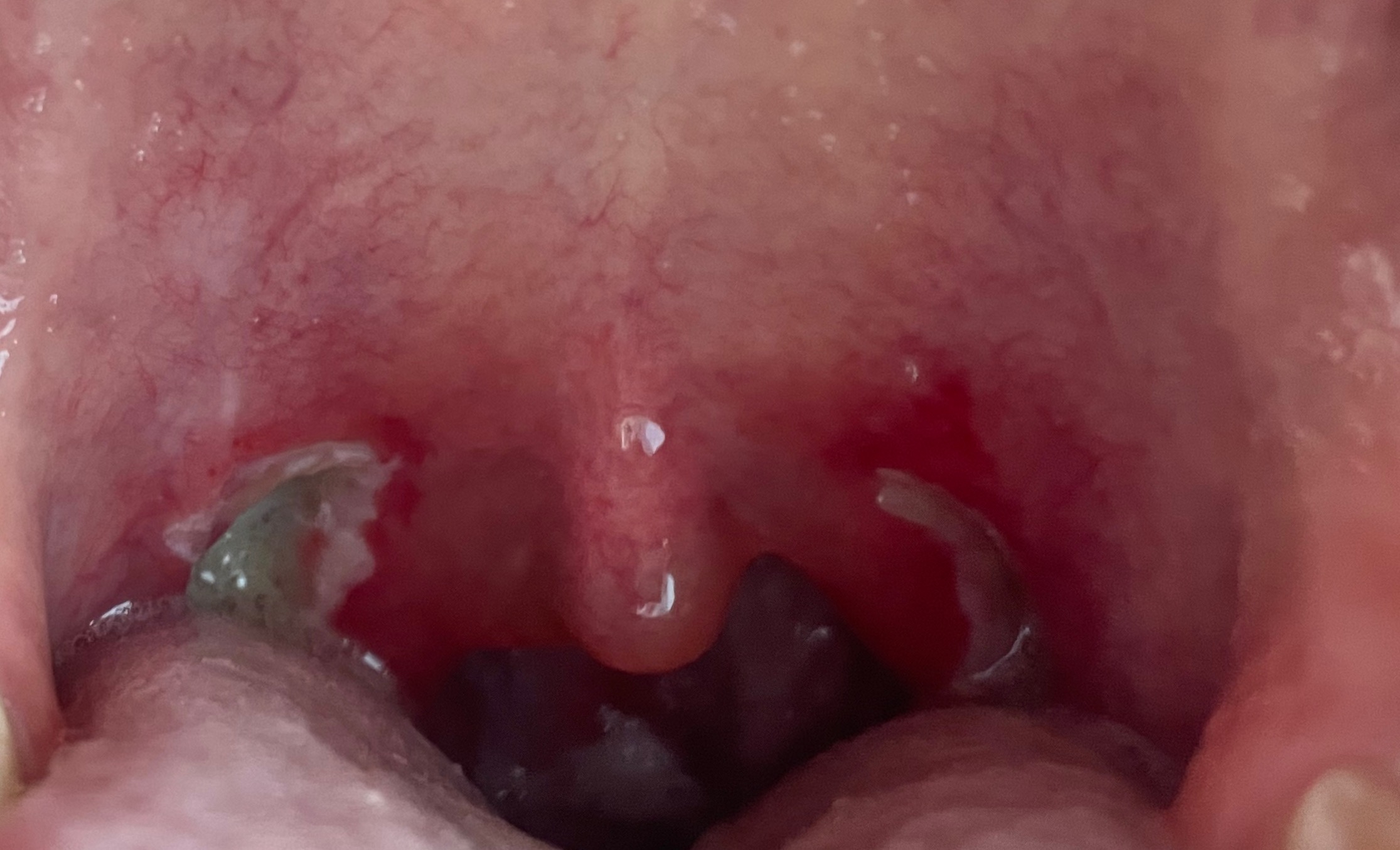 편도 절제 수술 후