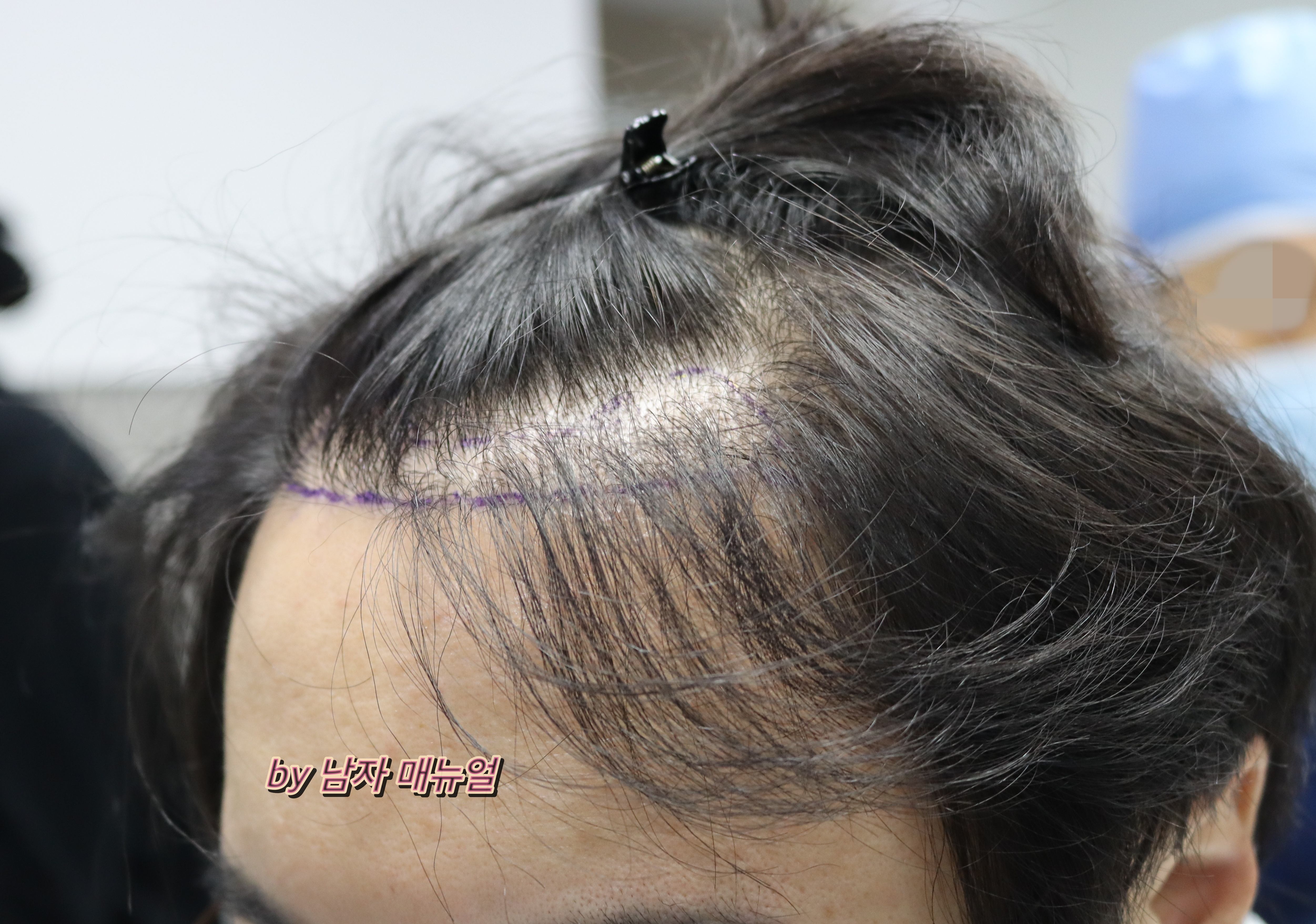 모발이식-전-사진