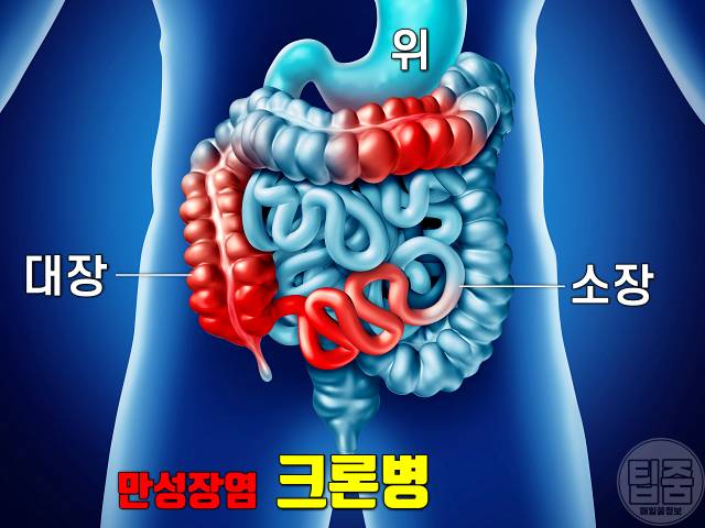 장 안좋을때 증상 장 안좋으면 여드름 주사비