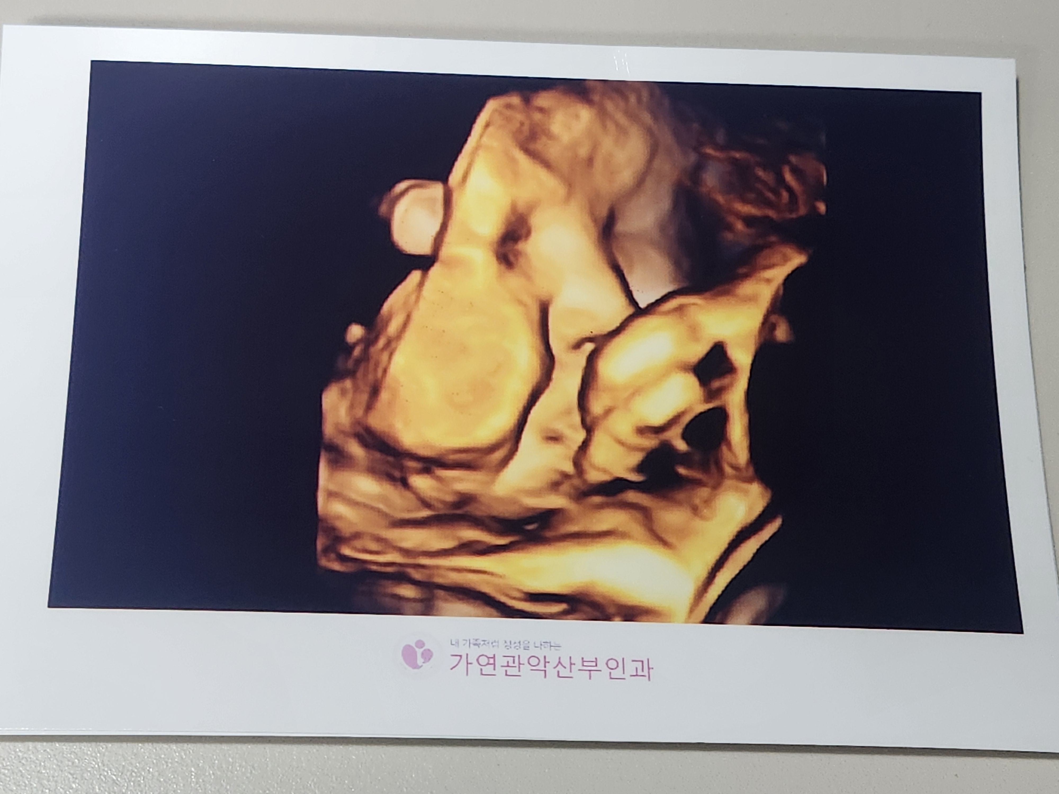 37주 초음파사진