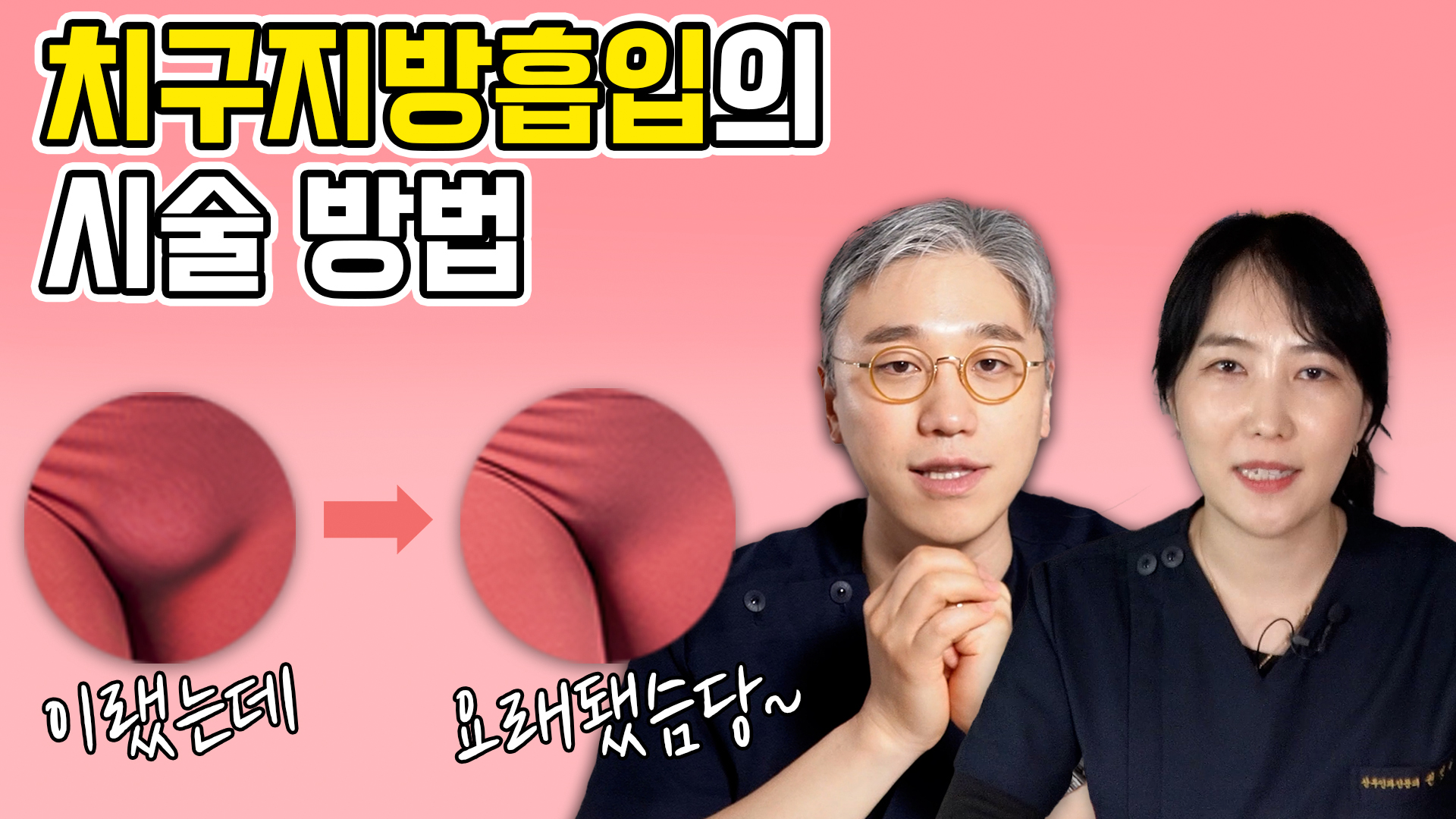 불룩한 음부지방흡입, 이렇게 하면 된다?