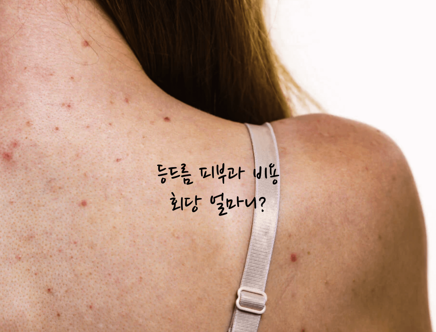 등드름