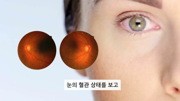 닥터눈 CVD 소프트웨어 설명 이미지