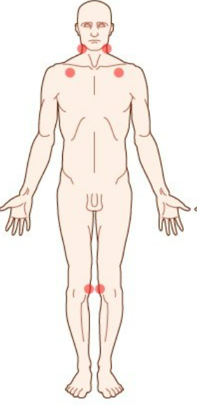 섬유근육통 증상과 치료법 총정리 만성 통증 잡는 방법은?