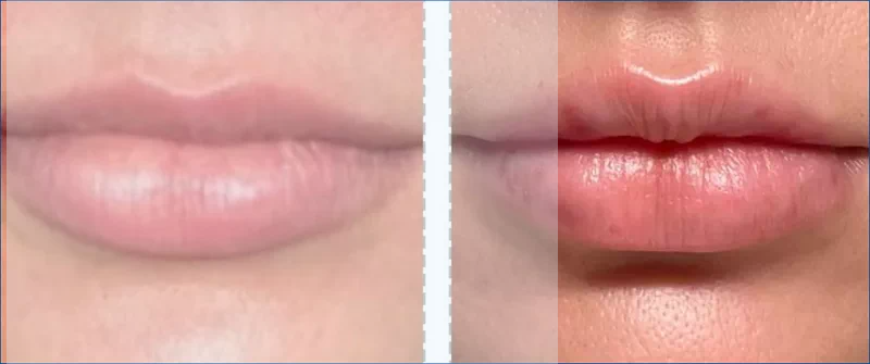 입술필러 전후