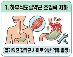 역류성 식도염