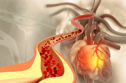 고지혈증 증상, 고지혈증에 좋은 음식, 고지혈증 수치 총정리 (2024ver)