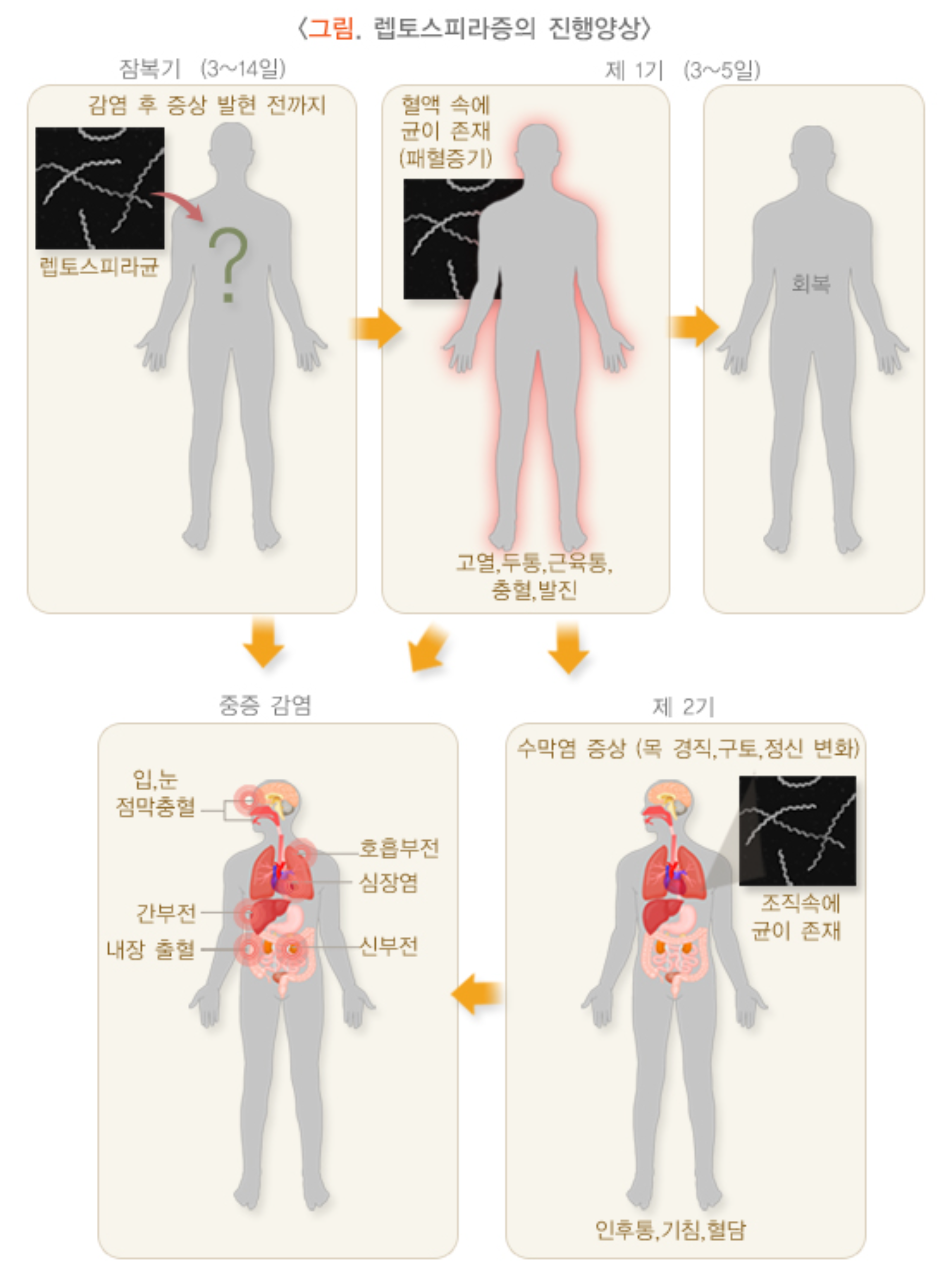 렙토스피라증 증상들