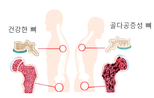 콘드로이친 효능 부작용