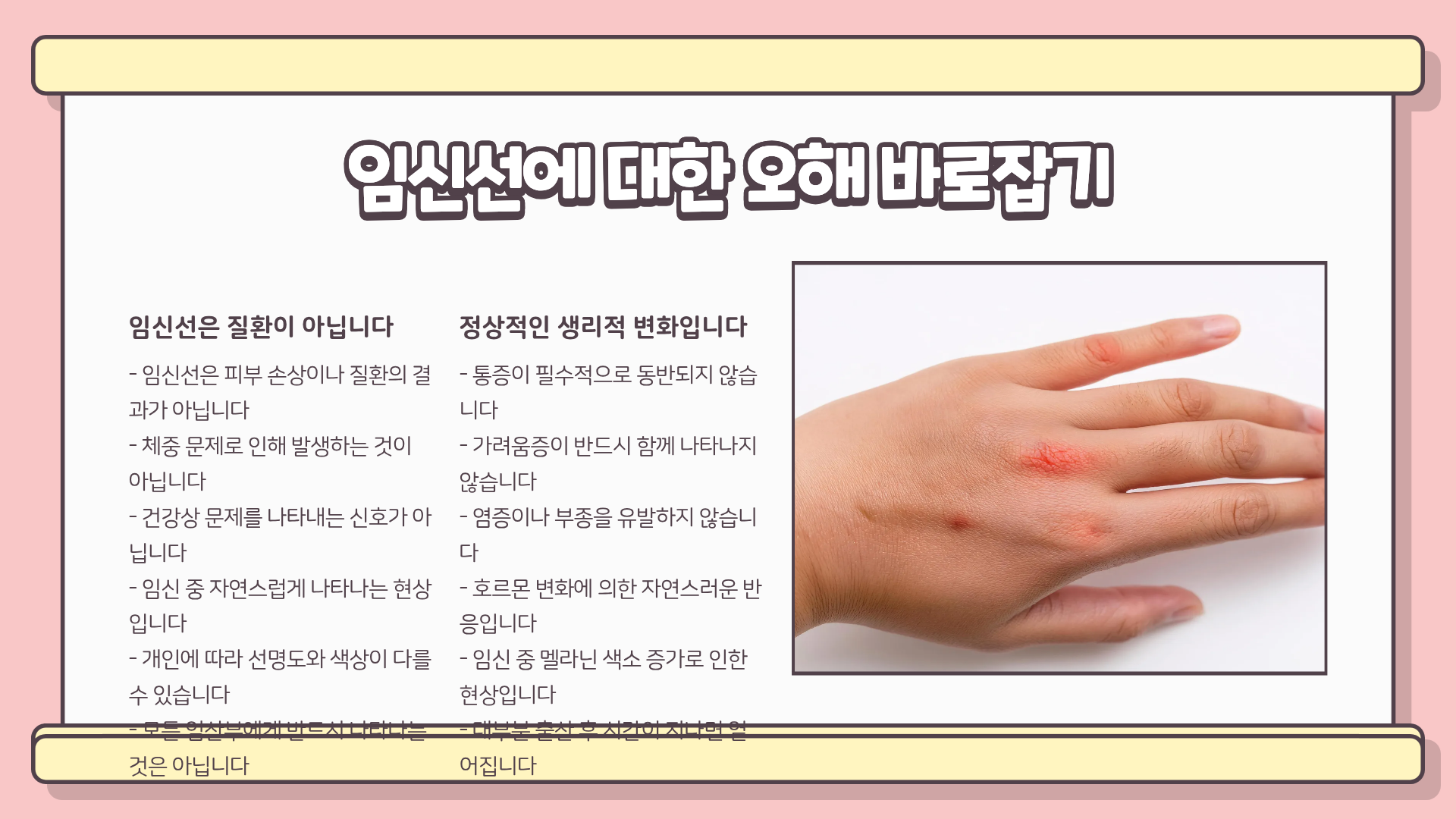 '임신선 생기는 시기'와 '임신선 생기는 이유' : 임신 중 몸에 나타나는 신호?