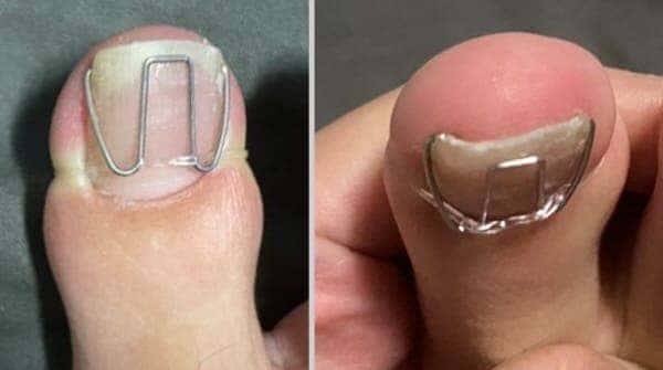 발톱교정기착용