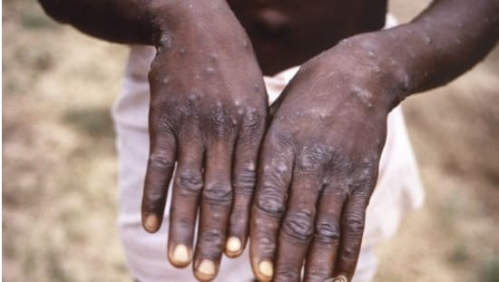 [병든 지구] 중국 촉발 코로나 펜데믹은 영원히 종식되지 않고 이어진다 UNAIDS calls for urgent global response to Monkey Pox Public Health Emergency