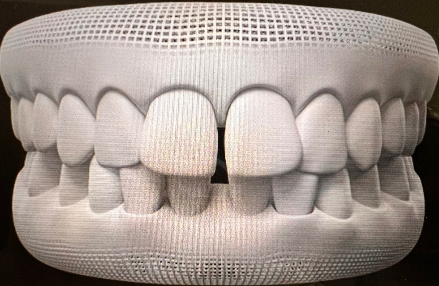 인비절라인 케이스&#44; 앞니 사이에 틈이 있는 벌어진 치아의 모습