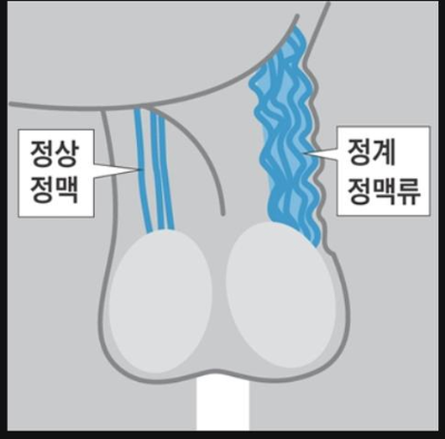정계정맥류 수술 후기