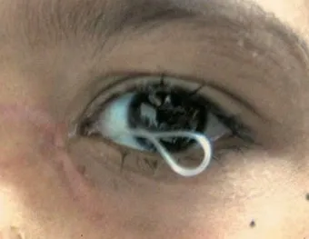 눈물샘 뚫는 수술 간단한가요에 대한 수술정보_9