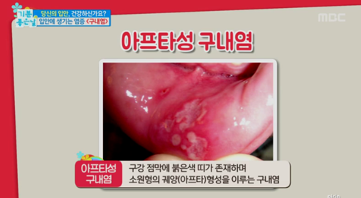 아프타성