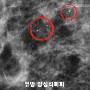 유방 양성석회화