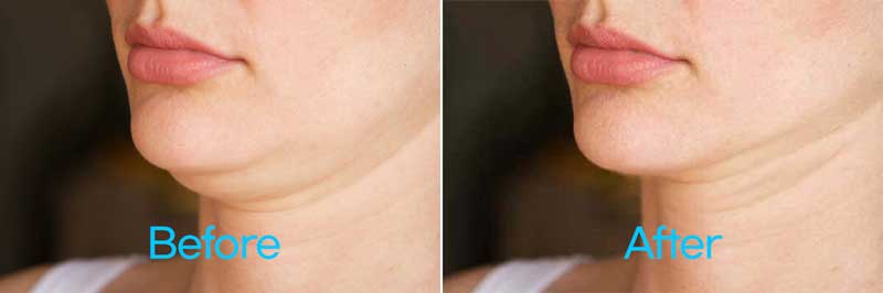 이중턱 보정 완성