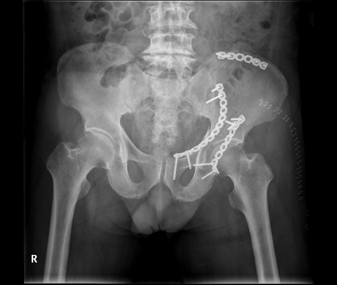 골반 골절의 이해와 치료