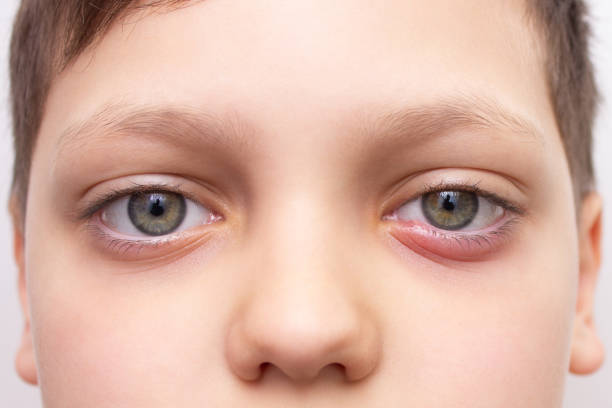 다래끼 빨리 낫는법