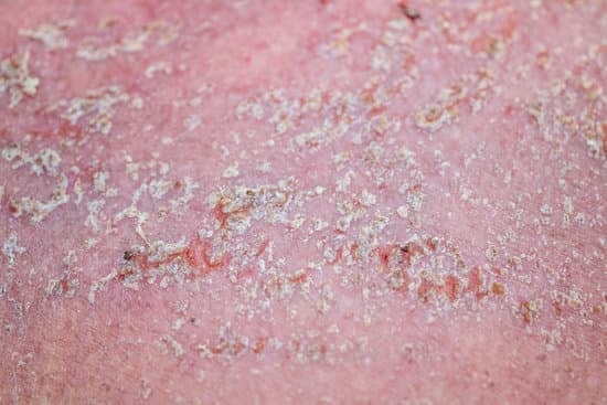 지루성 피부염(Seborrheic Dermatitis): 원인, 증상, 치료법 총정리