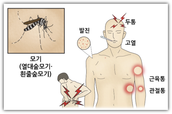 치쿤구니야 열병