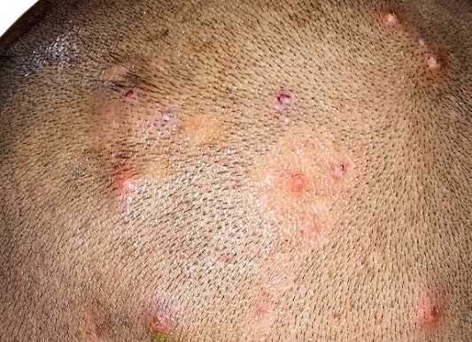 세균성 모낭염 두피