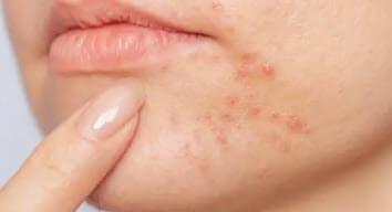 🤔턱에 여드름이 반복되는 이유, 호르몬 때문일 수 있습니다