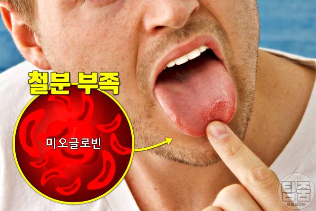 철분 부족 증상 설염 구내염