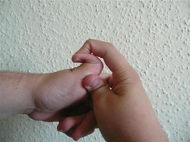 엘러스 단로스 증후군 환자의 과운동 관절