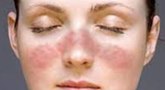 루푸스 증상 진단 검사 치료방법