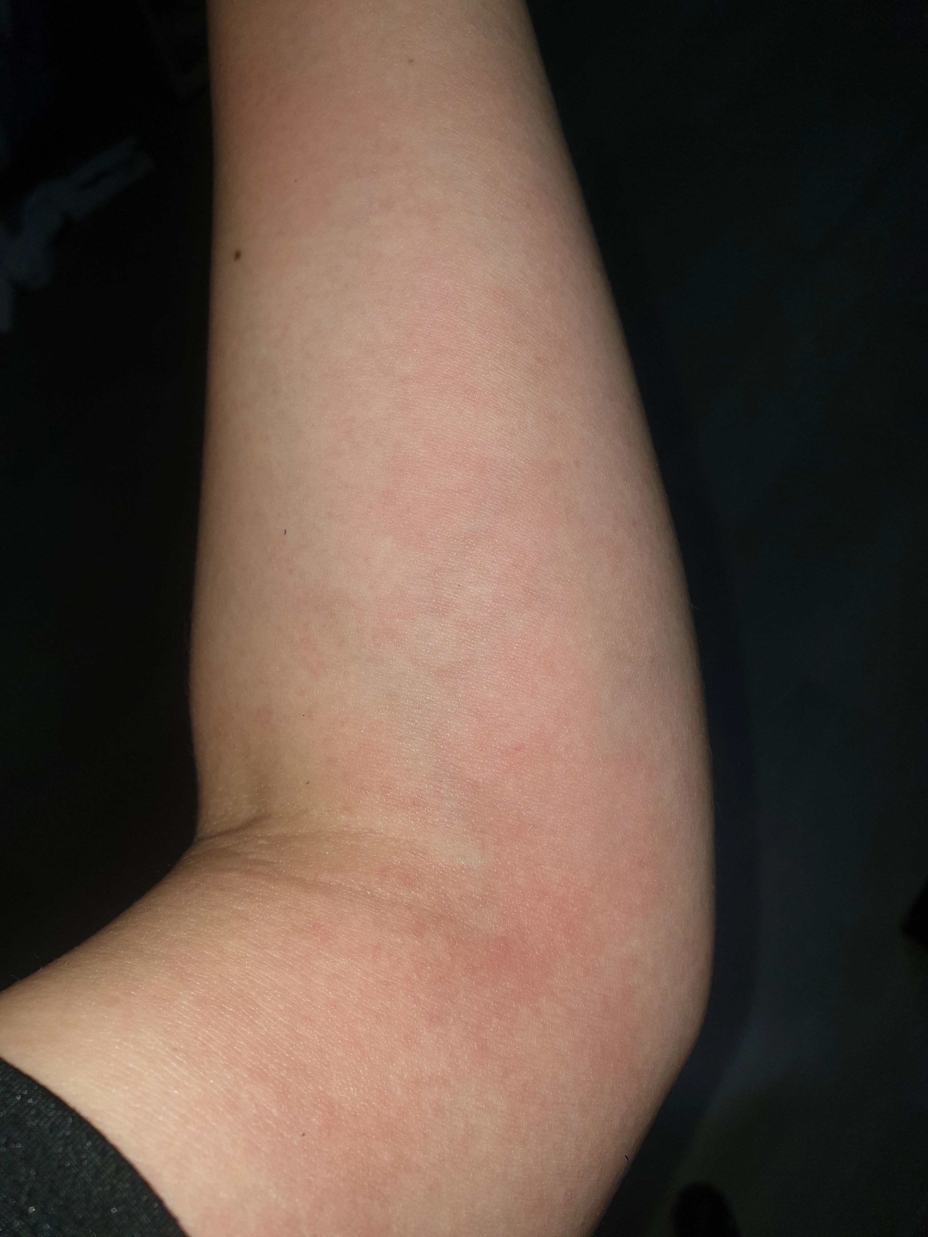 햇빛 알레르기 원인