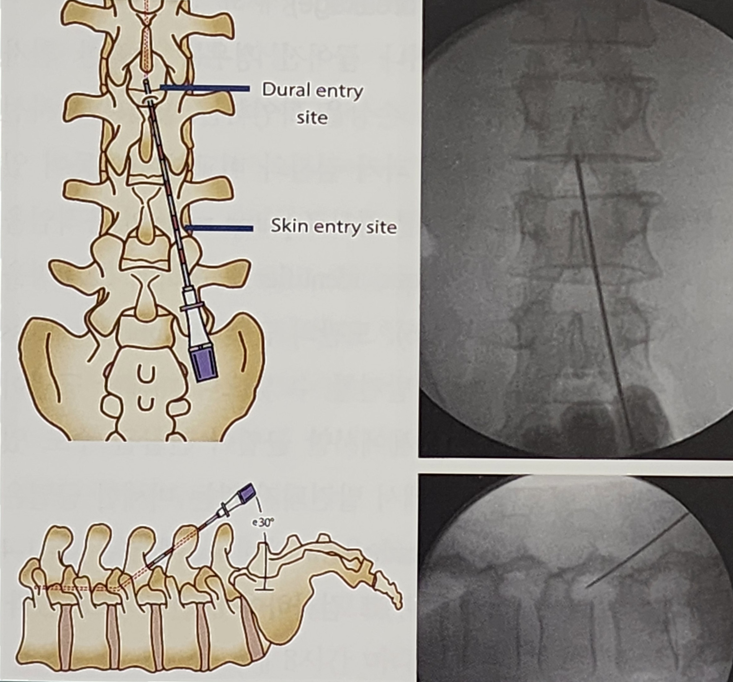 뇌성마비의 수술적 치료2