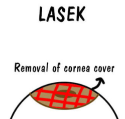 투데이라섹 수술 후기