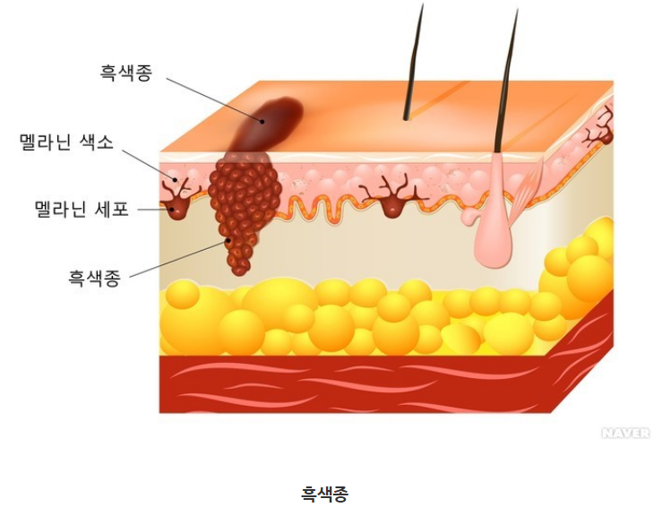 악성-흑색종-사진