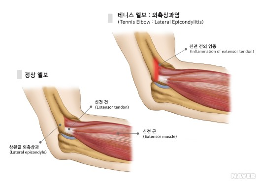 엘보