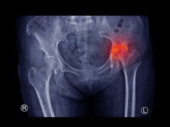 대퇴골두 무혈성 괴사증